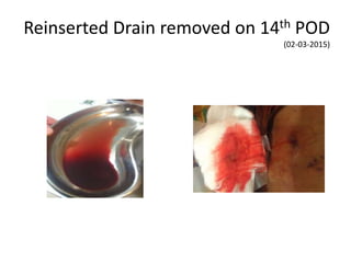 Reinserted Drain removed on 14th POD
(02-03-2015)
 