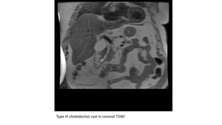 Type III choledochal cyst in coronal T2WI
 