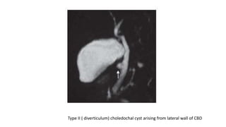 Type II ( diverticulum) choledochal cyst arising from lateral wall of CBD
 