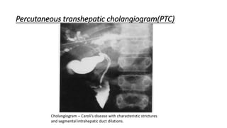 Percutaneous transhepatic cholangiogram(PTC)
Cholangiogram – Caroli’s disease with characteristic strictures
and segmental intrahepatic duct dilations.
 