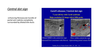 Central dot sign
-enhancing fibrovascular bundle of
portal vein radicles completely
surrounded by dilated bile ducts
 