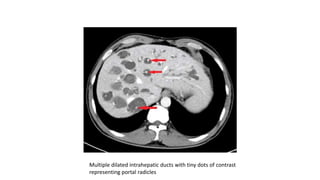 Multiple dilated intrahepatic ducts with tiny dots of contrast
representing portal radicles
 