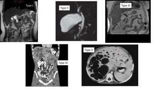 Type I
Type II
Type III
Type IV
Type V
 