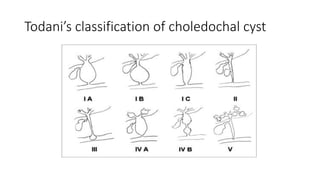 Todani’s classification of choledochal cyst
 