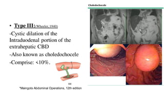 • Type III:(Wheeler, 1940)
-Cystic dilation of the
Intraduodenal portion of the
extrahepatic CBD
-Also known as choledochocele
-Comprise: <10%.
*Maingots Abdominal Operations, 12th edition
 