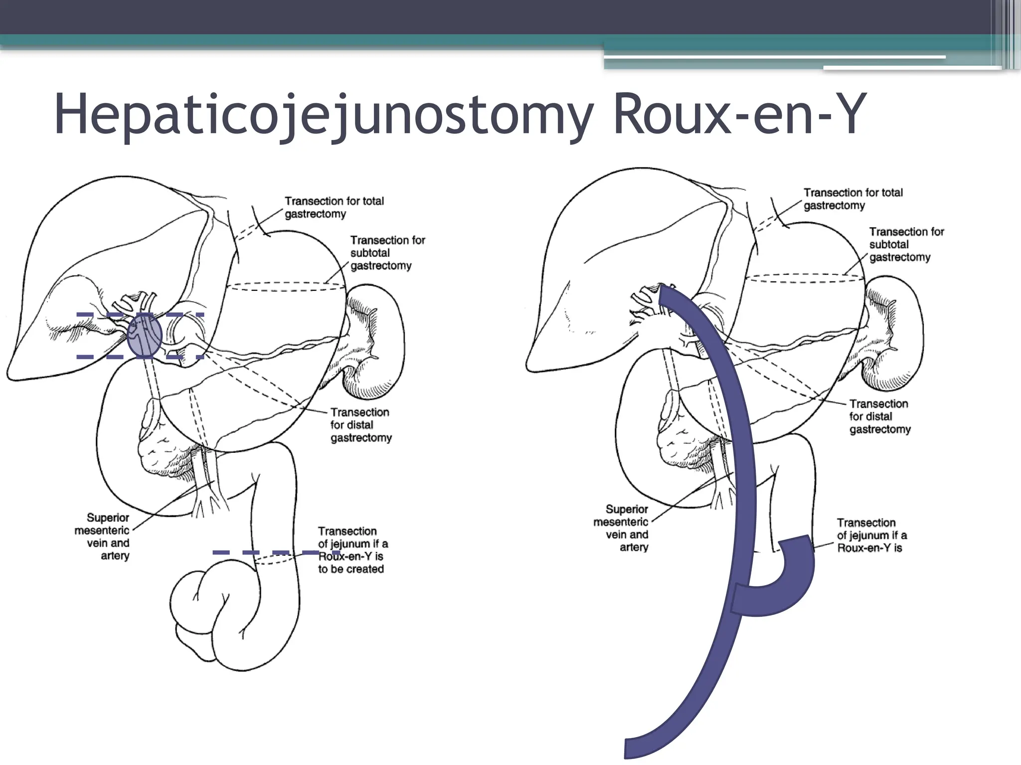 Choledochalcyst Introduction Diagnosis And Management pptx choledochalcyst-introduction-diagnosis-and-management-pptx