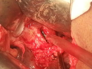 case of choledocholithiasis and its management.pptx