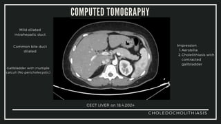 Choledocholithiasis Risk CASE STUDY ON CHOLEDOCHOLITHIASIS CLINICAL PRACTICE.pdf