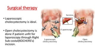 Surgical therapy
• Laparoscopic
cholecystectomy is ideal.
• Open cholecystectomy is
done if patient unfit for
laparoscopy through Right
Sub-costal(KOCHERS’s)
incision.
 