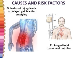 CAUSES AND RISK FACTORS
Spinal cord injury leads
to delayed gall bladder
emptying
Prolonged total
parenteral nutrition
 