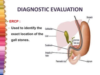 DIAGNOSTIC EVALUATION
ERCP :
• Used to identify the
exact location of the
gall stones.
 