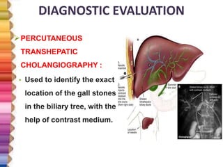 DIAGNOSTIC EVALUATION
PERCUTANEOUS
TRANSHEPATIC
CHOLANGIOGRAPHY :
• Used to identify the exact
location of the gall stones
in the biliary tree, with the
help of contrast medium.
 