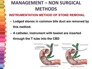 MANAGEMENT – NON SURGICAL
METHODS
• INSTRUMENTATION METHOD OF STONE REMOVAL
– Lodged stones in common bile duct are removed by
this method.
– A catheter, instrument with basket are inserted
through the T tube into the CBD
 