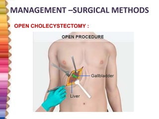 MANAGEMENT –SURGICAL METHODS
• OPEN CHOLECYSTECTOMY :
 