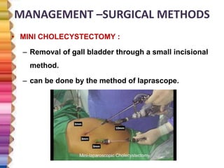 MANAGEMENT –SURGICAL METHODS
• MINI CHOLECYSTECTOMY :
– Removal of gall bladder through a small incisional
method.
– can be done by the method of laprascope.
 