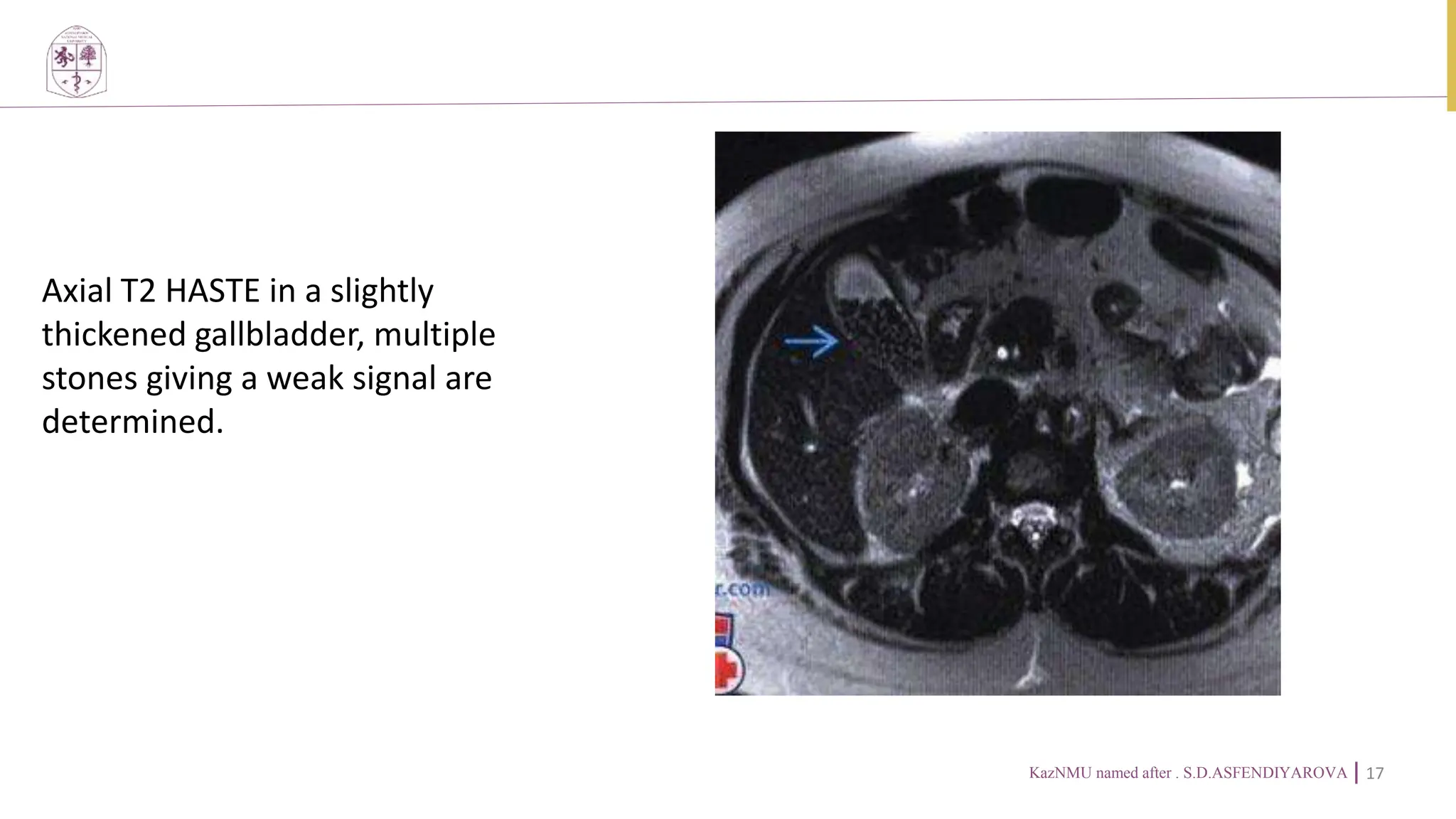 Cholelithiasis full description radiology | PPTX