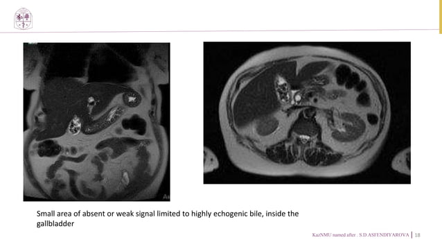 Cholelithiasis full description radiology | PPTX
