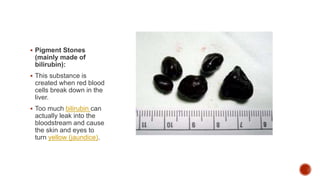  Pigment Stones
(mainly made of
bilirubin):
 This substance is
created when red blood
cells break down in the
liver.
 Too much bilirubin can
actually leak into the
bloodstream and cause
the skin and eyes to
turn yellow (jaundice).
 