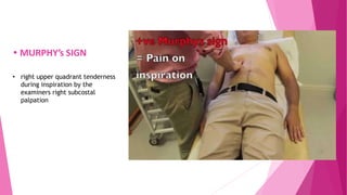 Murray Sign Cholelithiasis | PPTX