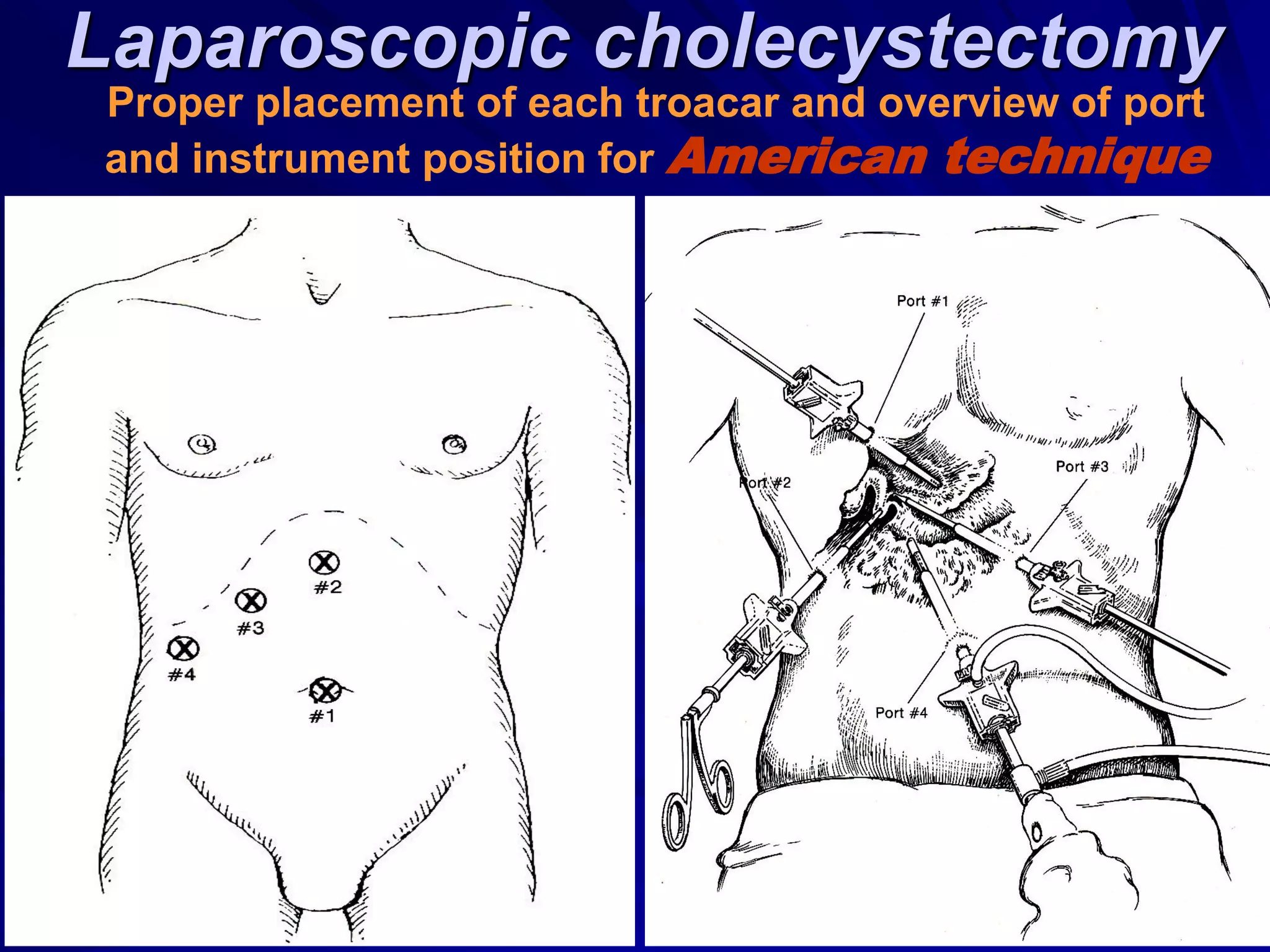 Laparoscopic cholecystectomy
Proper placement of each troacar and overview of port
and instrument position for American technique
 
