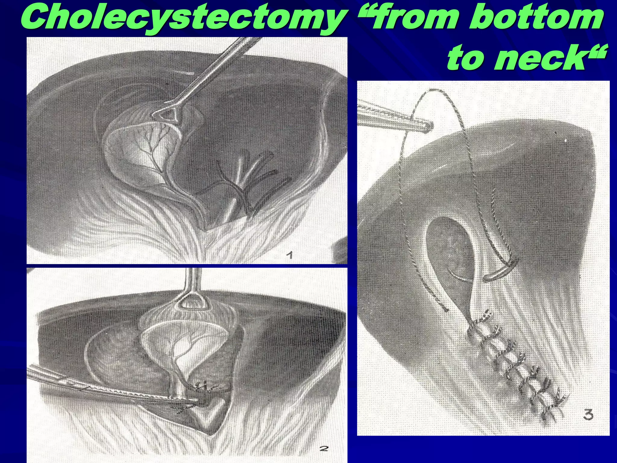 Cholecystectomy “from bottom
to neck“
 