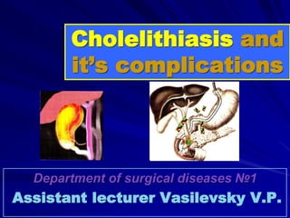 Cholelithiasis and
it’s complications
Department of surgical diseases №1
Assistant lecturer Vasilevsky V.P.
 