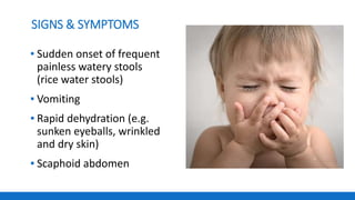 SIGNS & SYMPTOMS
▪ Sudden onset of frequent
painless watery stools
(rice water stools)
▪ Vomiting
▪ Rapid dehydration (e.g.
sunken eyeballs, wrinkled
and dry skin)
▪ Scaphoid abdomen
 