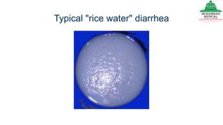 Typical "rice water" diarrhea
 