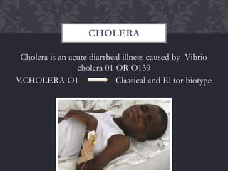 Cholera is an acute diarrheal illness caused by Vibrio
cholera 01 OR O139
V.CHOLERA O1 Classical and El tor biotype
CHOLERA
 