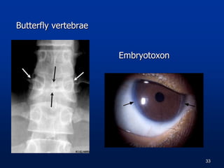 Butterfly vertebrae
Embryotoxon
33
 