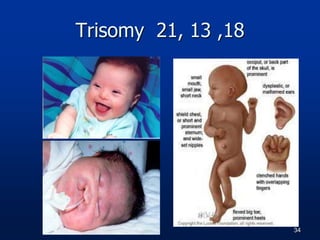 Trisomy 21, 13 ,18
34
 
