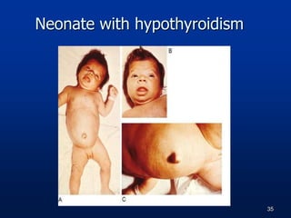 Neonate with hypothyroidism
35
 