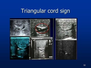 Triangular cord sign
52
 