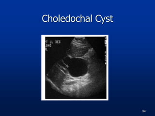 Choledochal Cyst
54
 