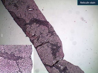 Reticulin stain
 