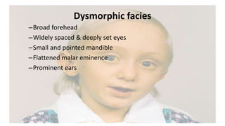 Dysmorphic facies
–Broad forehead
–Widely spaced & deeply set eyes
–Small and pointed mandible
–Flattened malar eminence
–Prominent ears
 