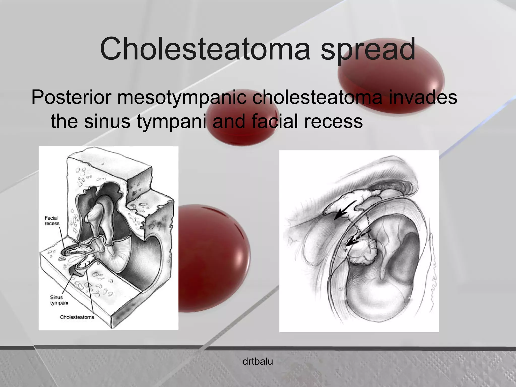 Cholesteatoma