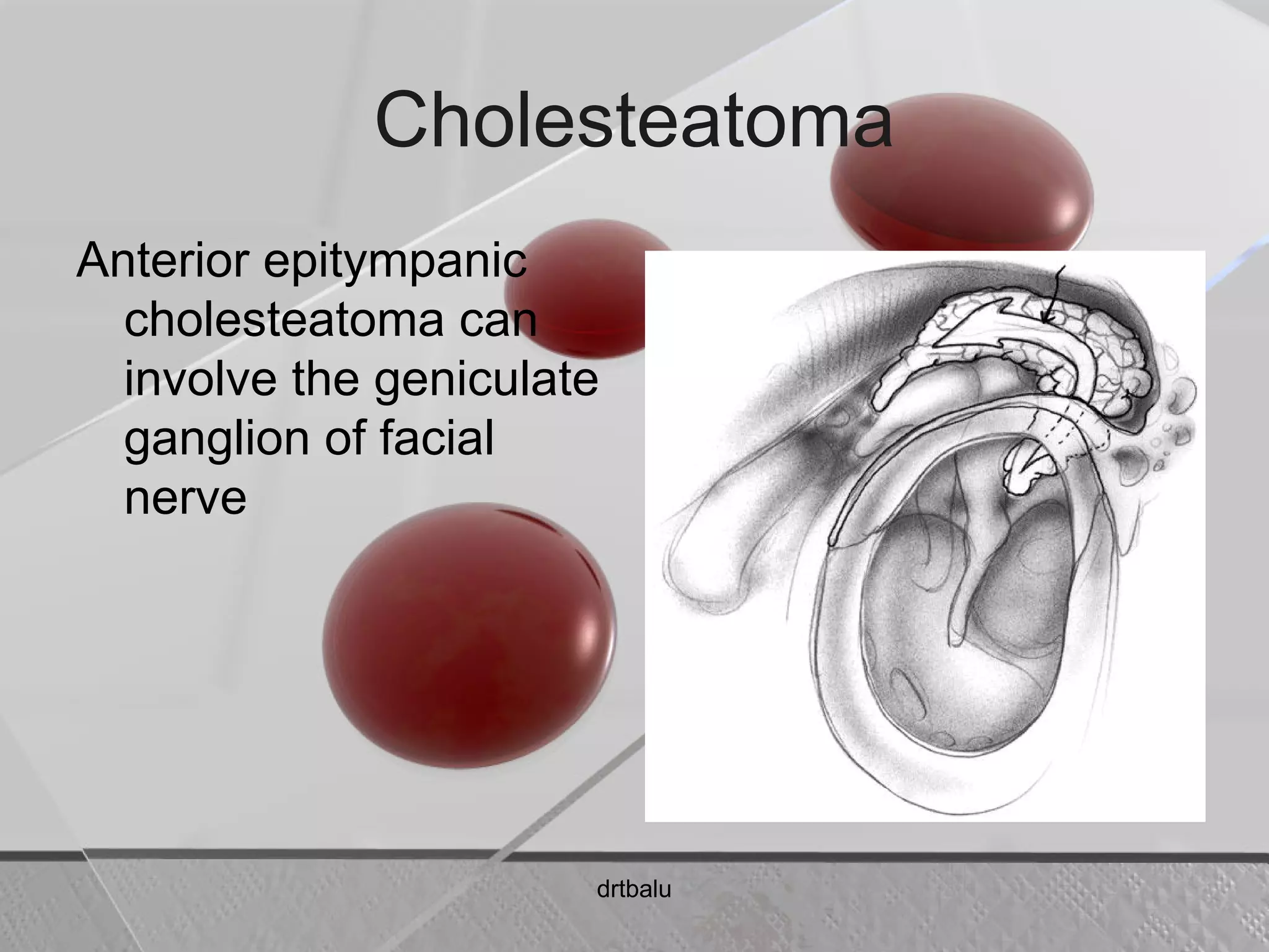 Cholesteatoma