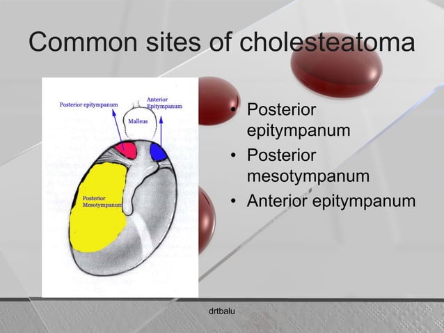 Cholesteatoma