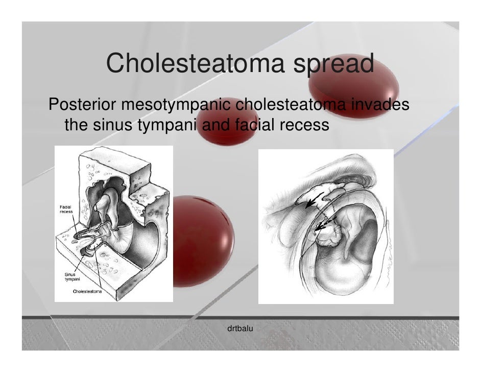 Cholesteatoma