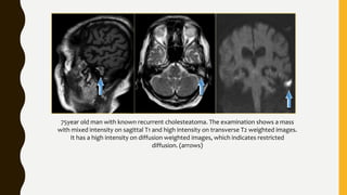 75year old man with known recurrent cholesteatoma. The examination shows a mass
with mixed intensity on sagittal T1 and high intensity on transverse T2 weighted images.
It has a high intensity on diffusion weighted images, which indicates restricted
diffusion. (arrows)
 