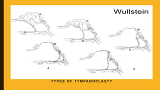 T Y P E S O F T Y M PA N O P L A S T Y
 