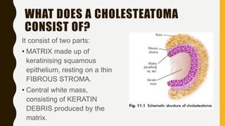 WHAT DOES A CHOLESTEATOMA
CONSIST OF?
It consist of two parts:
• MATRIX made up of
keratinising squamous
epithelium, resting on a thin
FIBROUS STROMA.
• Central white mass,
consisting of KERATIN
DEBRIS produced by the
matrix.
 