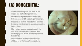 (A) CONGENITAL:
• Arises from embryonic cell rests in the
middle ear cleft or temporal bone.
• Occurs at 3 important sites: Middle ear,
Petrous Apex and Cerebello-pontine angle.
• Presents as a white mass behind an intact
tympanic membrane and causes conductive
hearing loss.
• May rupture spontaneously through the
tympanic membrane and present with
discharging ear, which is indistinguishable
from CSOM
• Discovered on routine examination of
children or at the time of myringotomy.
 