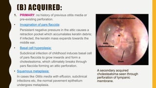 (B) ACQUIRED:
1. PRIMARY: no history of previous otitis media or
pre-existing perforation.
• Invagination of pars flaccida:
Persistant negative pressure in the attic causes a
retraction pocket which accumalates keratin debris;
if infected, the keratin mass expands towards the
middle ear.
• Basal cell hyperplasia:
Subclinical infection of childhood induces basal cell
of pars flaccida to grow inwards and form a
cholesteatoma, which ultimately breaks through
pars flaccida forming an attic perforation.
• Squamous metaplasia:
In cases like Otitis media with effusion, subclinical
infections etc, the normal pavement epithelium
undergoes metaplasia.
A secondary acquired
cholesteatoma seen through
perforation of tympanic
membrane.
 