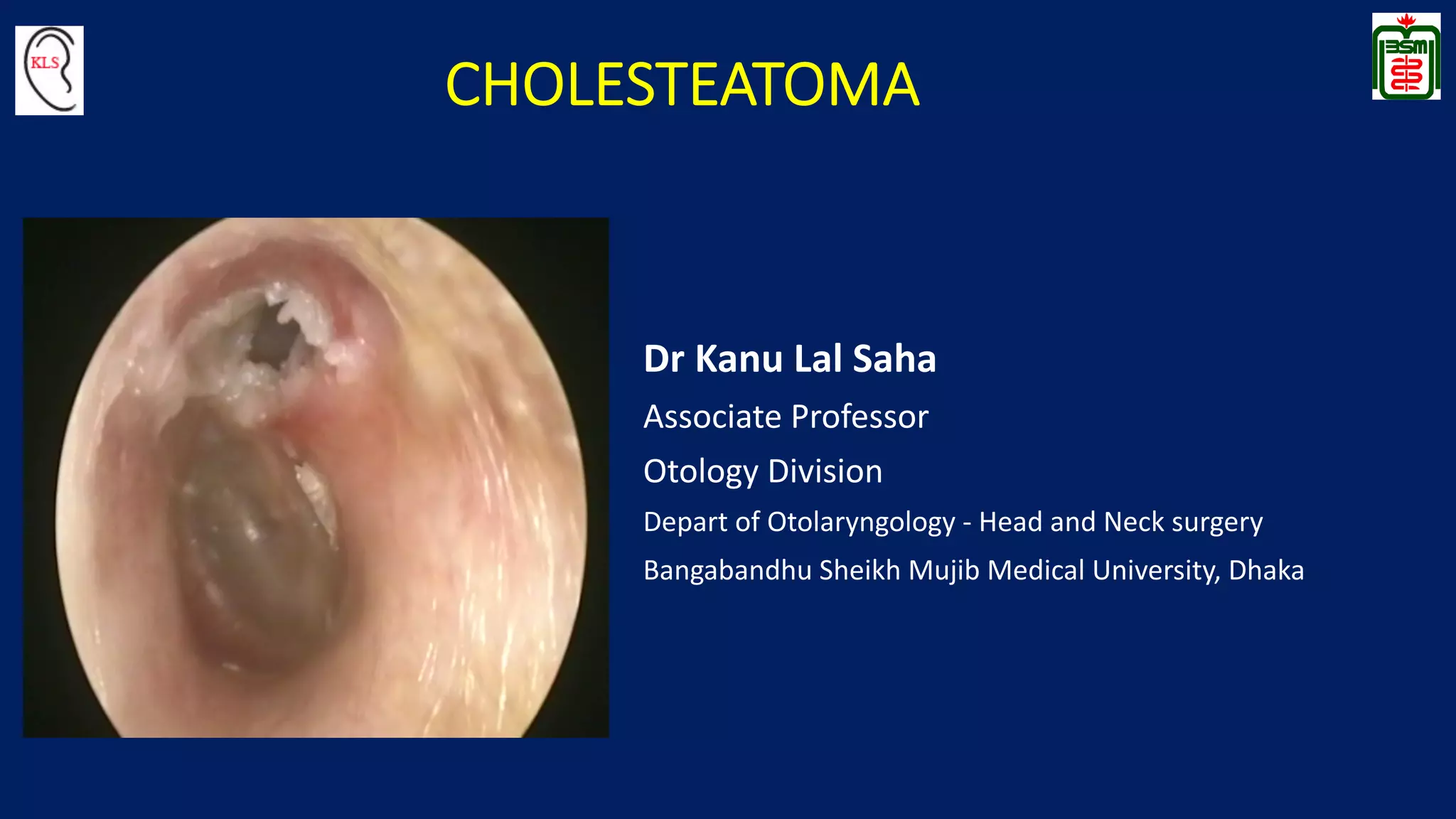 Cholesteatoma PDF