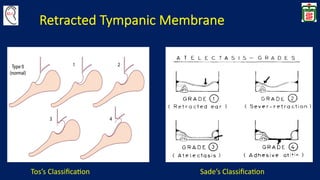 Sade Classification Cholesteatoma | PDF