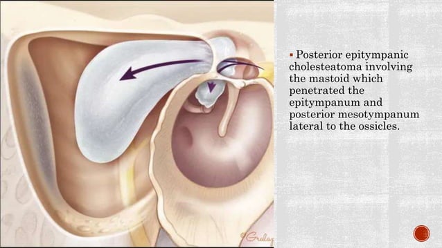 Cholesteatoma etiology, theories, clinical features and management ...