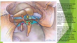 Cholesteatoma: General Considerations by dr rajendra singh lakhawat | PPTX