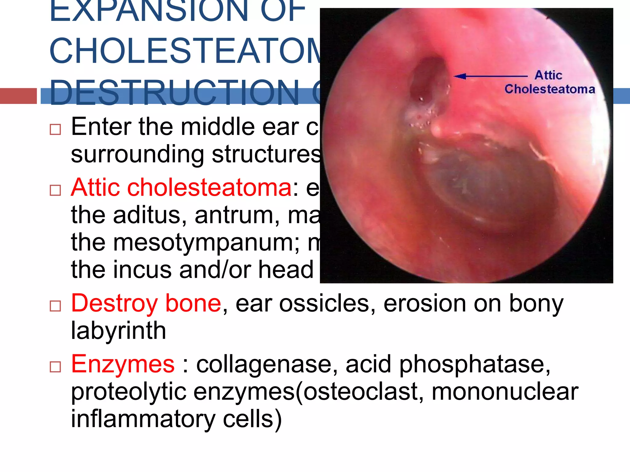 Cholesteatoma and chronic suppurative otitis media | PPTX